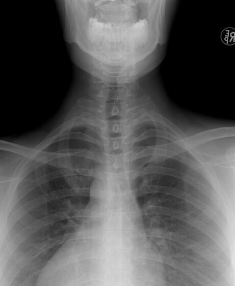 Grafika przedstawia zdjęcie klatki piersiowej człowieka